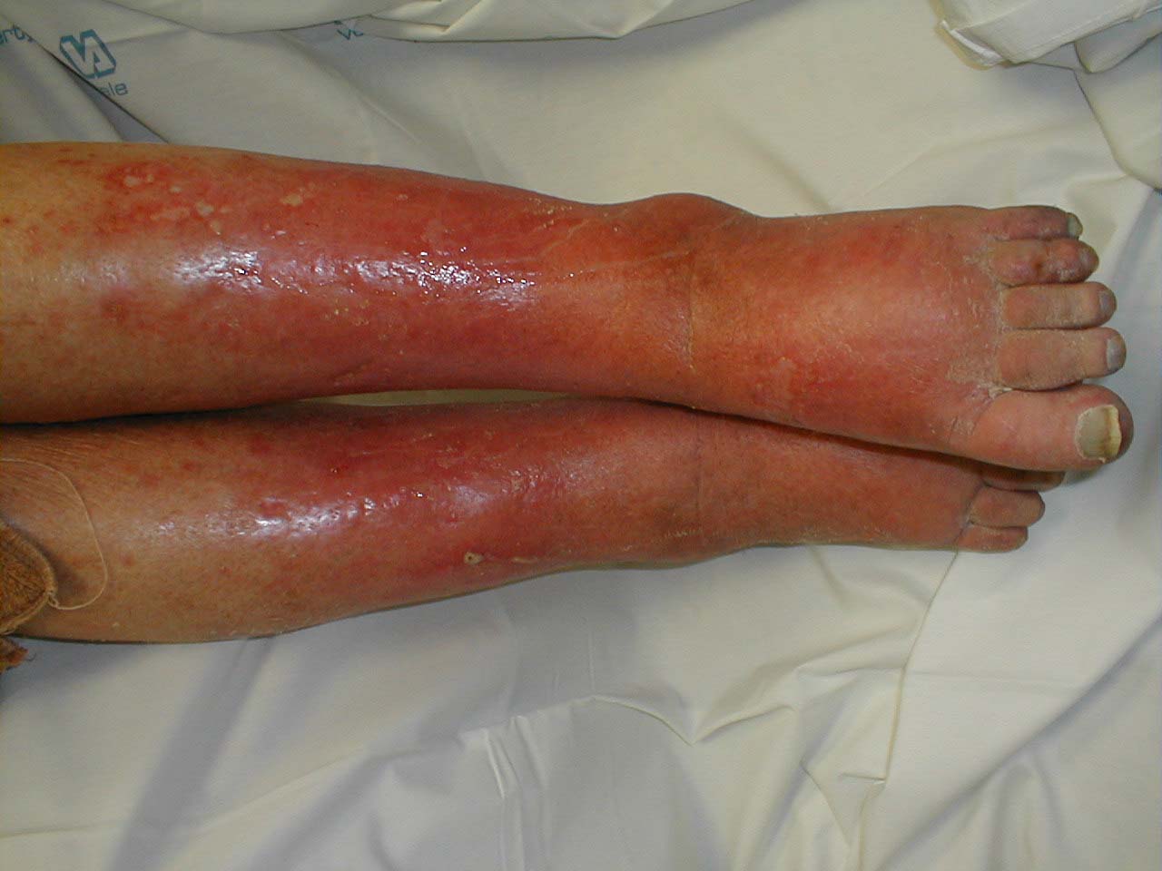 Picture of infection legscellulitis .