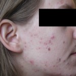 acne before photo