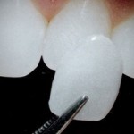 veneer Sycamore dental