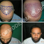 Fue hair transplant in Pakistan