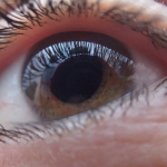 Laser Eye Surgeries